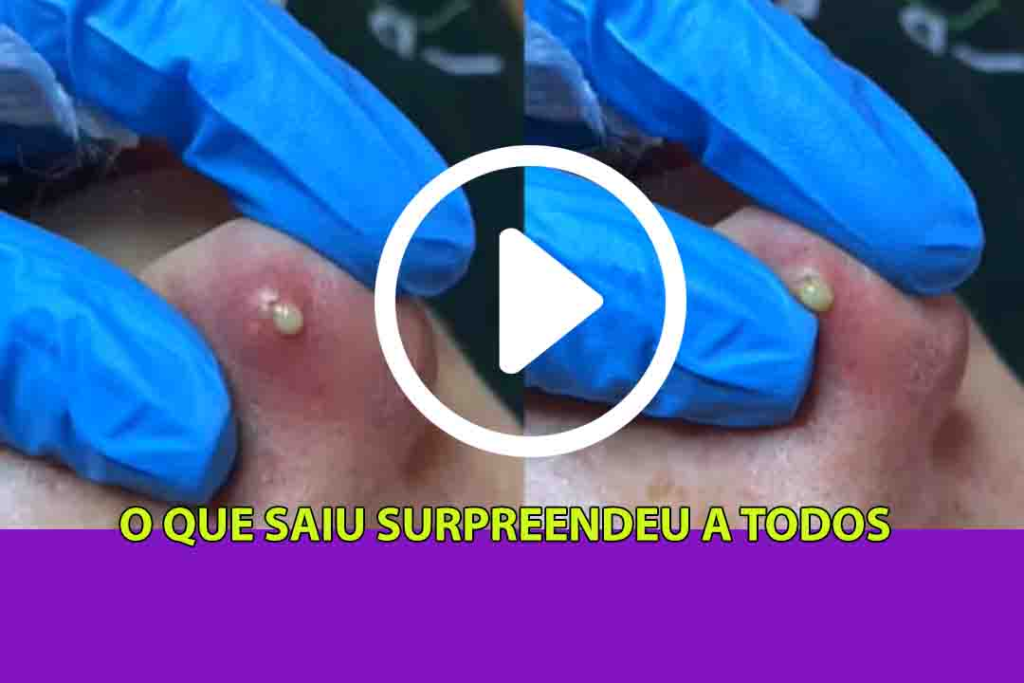 Nem Os Médicos Acreditaram No Que Saiu Daquela Espinha No Nariz; Assista Ao Vídeo