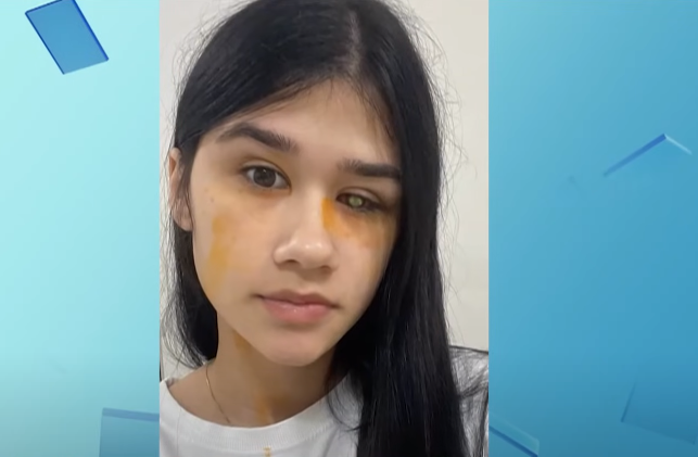 Chocante: Jovem fica cega após usar lentes de contato nos olh…Veja o vídeo