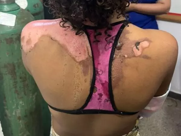 Mulher Joga Água Quente Na Sobrinha de 14 Anos Por Ciúmes do Marid…Ver Mais