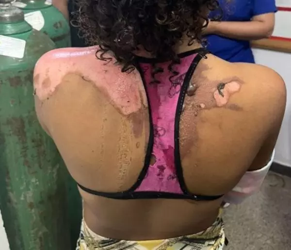 Mulher Joga Água Quente Na Sobrinha de 14 Anos Por Ciúmes do Marid…Ver Mais