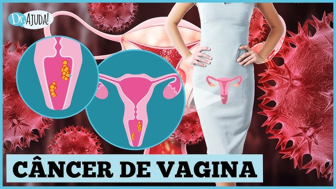 Médico Revela 07 Coisas Que Toda Mulher Faz Que Pode Causar Câncer Dentr0 Da Vag!n…Ver mais