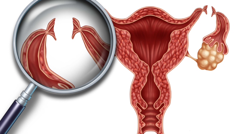 Ginecologista Revela 05 Coisas Que Toda Mulher Faz Que Pode Causar Câncer nas Trompas: “Dorm..Ver mais