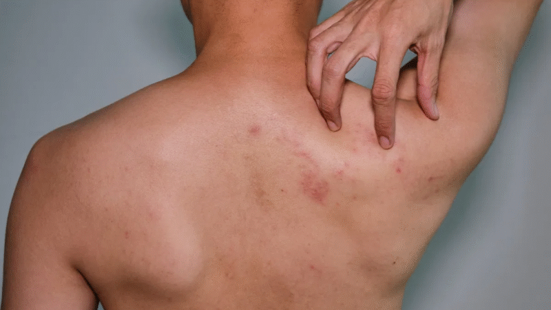 Médicos Alertam: 05 Sintomas da Catapora Em Mulheres Que Muitas Ignoram: “Est…Ver mais