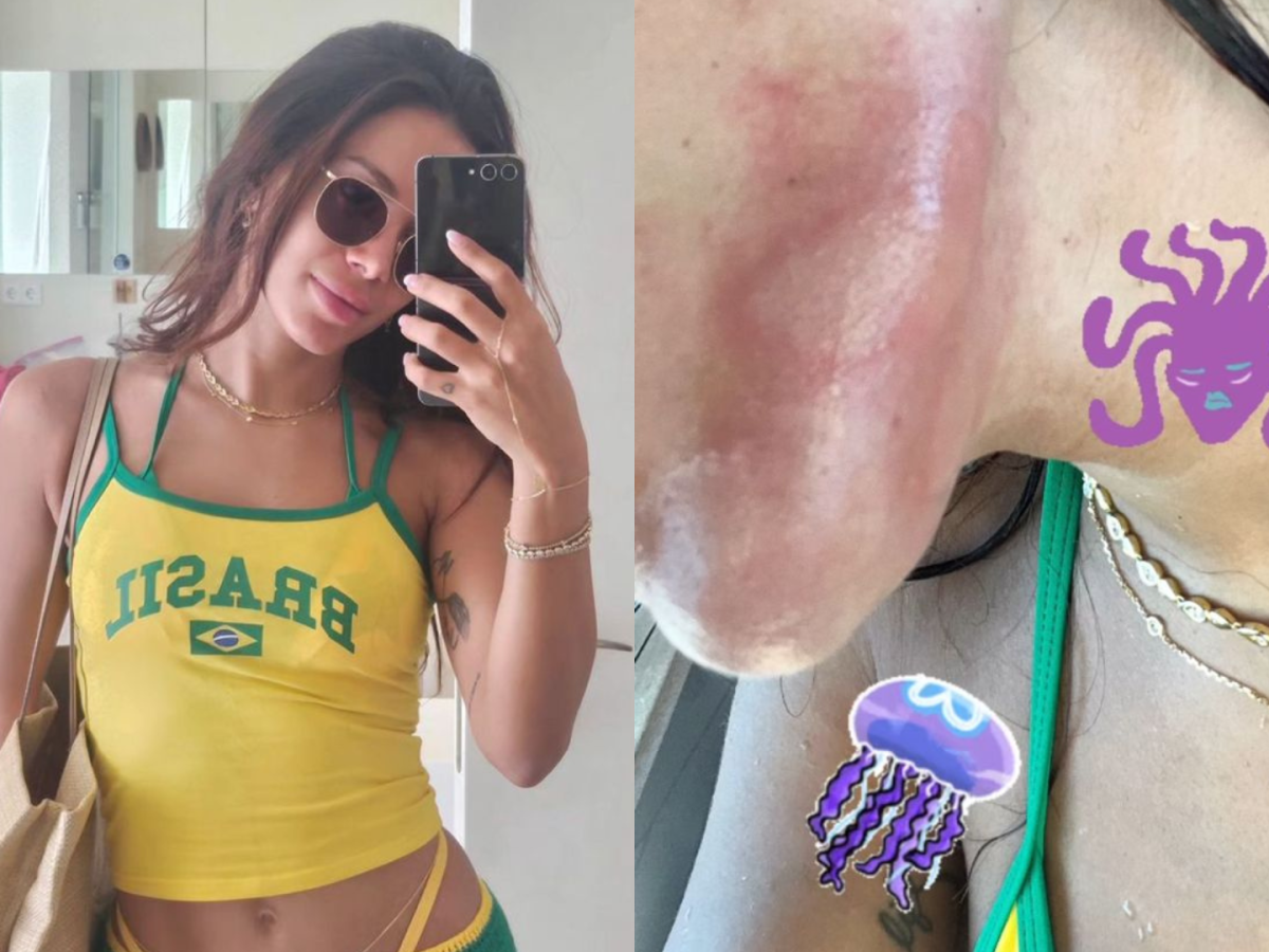 Nossa Querida Anitta Acaba de Sofrer Queimadura Dentro Da Sua…Ver mais