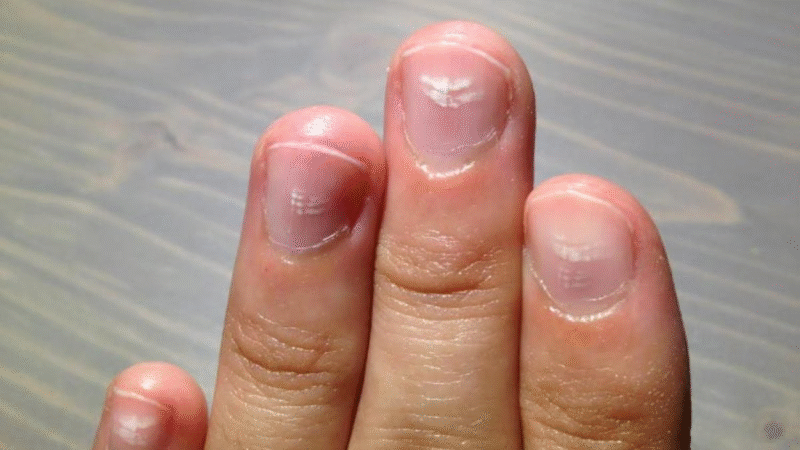 Médicos Alertam Que Esta Mancha Branca Nas Unhas Pode Ser Sinal de Ca…Ver mais