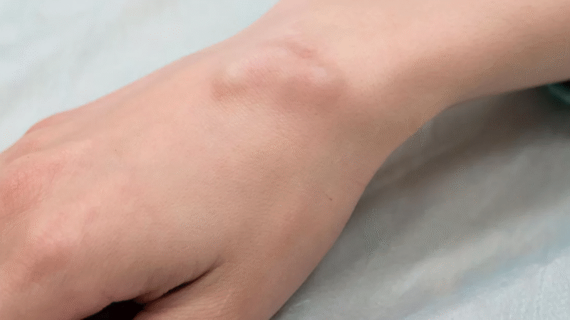 Ela Estourou Sem Querer Cisto Debaixo dos Braços e Médico Se Assustou Ao Sair Pedaç…Ver vídeo