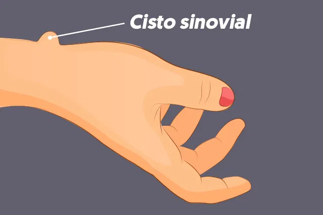 Cisto Na Mão Pode Surgir Na Vida Das Mulheres Que Fazem Se…Ver mais