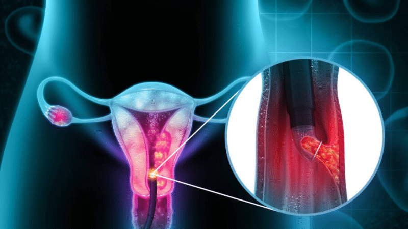 Câncer de Vulva Pode Surgir Na Vida Das Mulheres Que Fazem Se…Ver mais