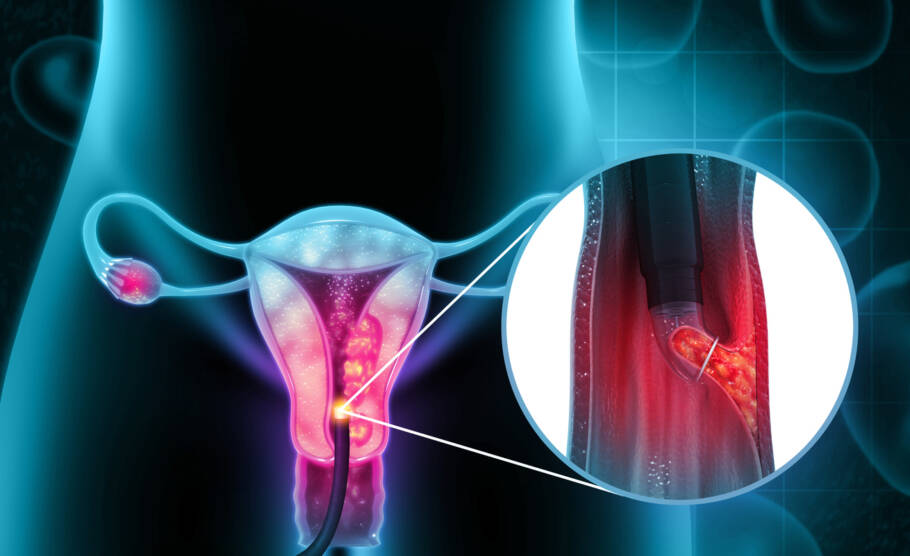 Câncer de Vulva Pode Surgir Na Vida Das Mulheres Que Fazem Se…Ver mais